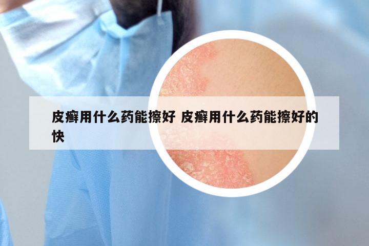 皮癣用什么药能擦好 皮癣用什么药能擦好的快