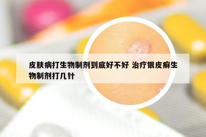 皮肤病打生物制剂到底好不好 治疗银皮癣生物制剂打几针