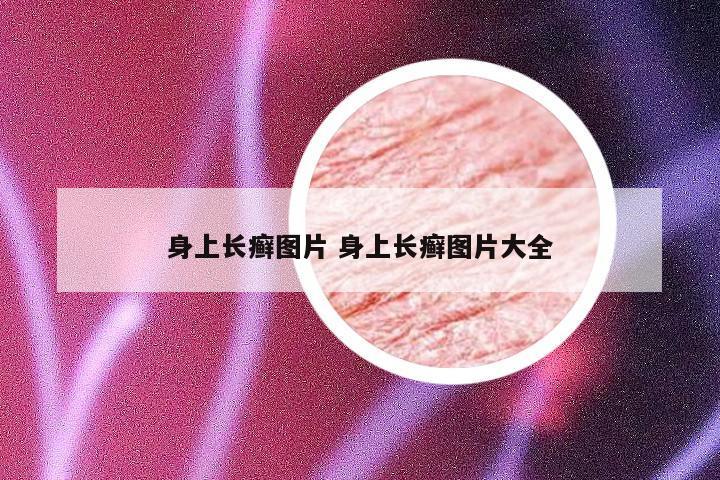 身上长癣图片 身上长癣图片大全