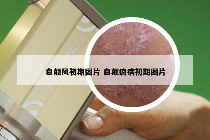 白颠风初期图片 白颠疯病初期图片