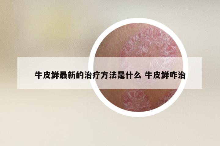 牛皮鲜最新的治疗方法是什么 牛皮鲜咋治