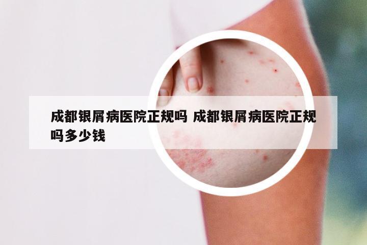 成都银屑病医院正规吗 成都银屑病医院正规吗多少钱