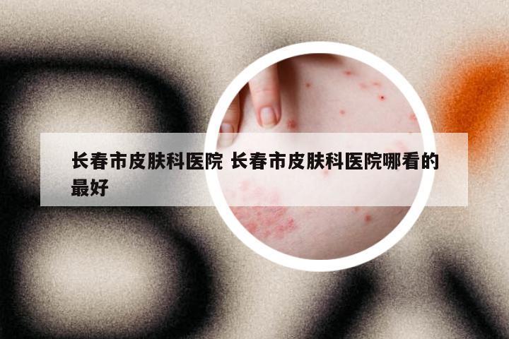 长春市皮肤科医院 长春市皮肤科医院哪看的最好