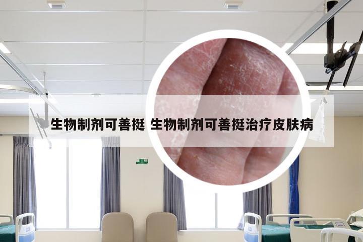 生物制剂可善挺 生物制剂可善挺治疗皮肤病