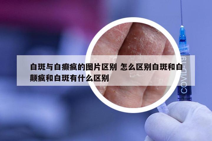 白斑与白癫疯的图片区别 怎么区别白斑和白颠疯和白斑有什么区别