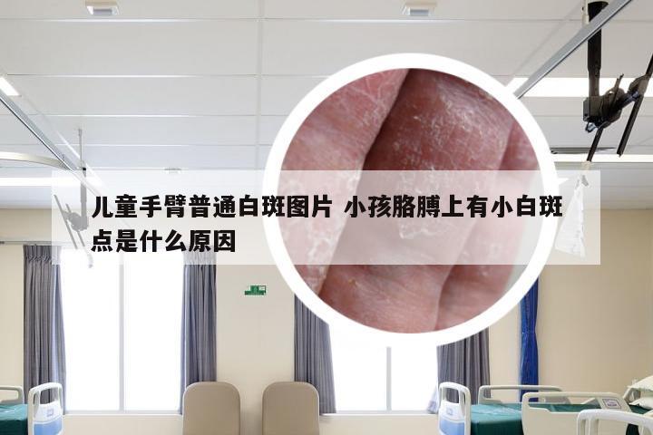 儿童手臂普通白斑图片 小孩胳膊上有小白斑点是什么原因