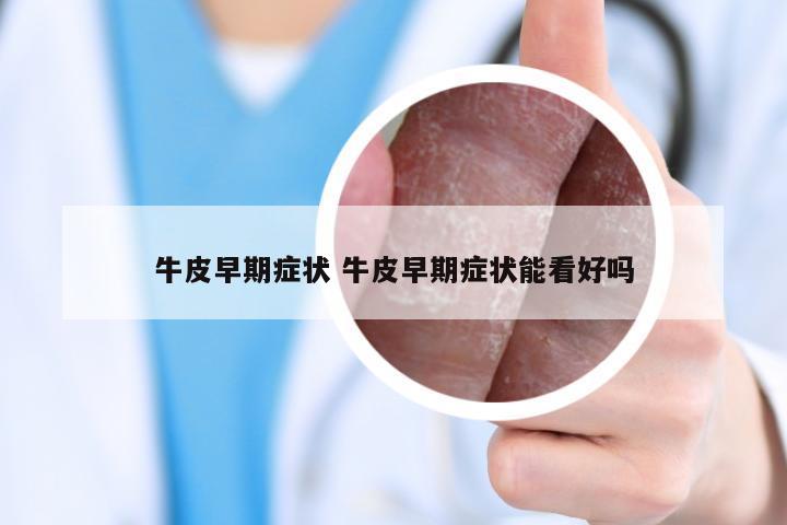 牛皮早期症状 牛皮早期症状能看好吗