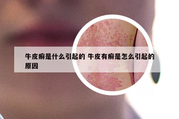牛皮癣是什么引起的 牛皮有癣是怎么引起的原因