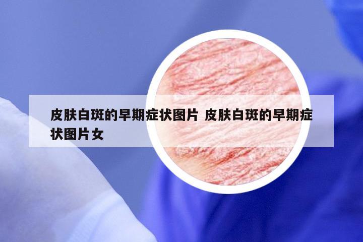 皮肤白斑的早期症状图片 皮肤白斑的早期症状图片女