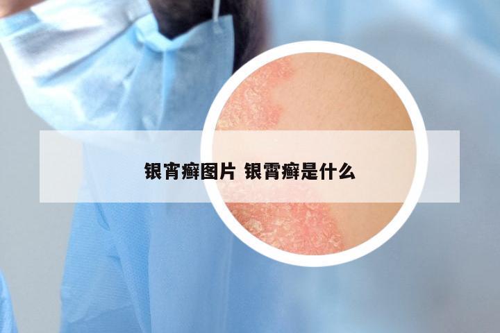 银宵癣图片 银霄癣是什么