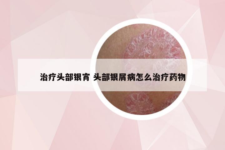 治疗头部银宵 头部银屑病怎么治疗药物