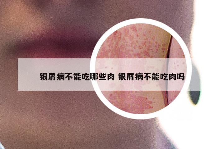 银屑病不能吃哪些肉 银屑病不能吃肉吗