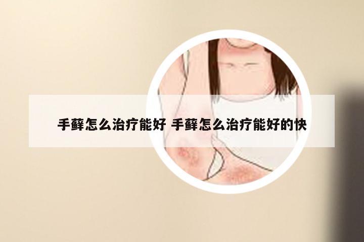 手藓怎么治疗能好 手藓怎么治疗能好的快