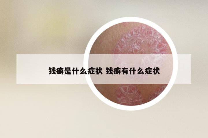 钱癣是什么症状 钱癣有什么症状
