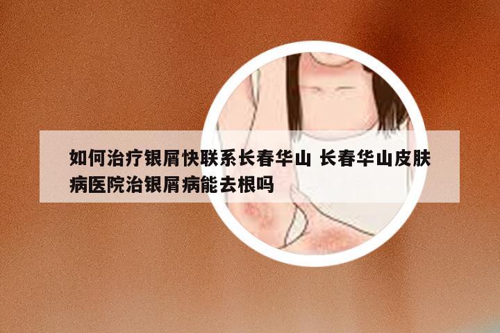 如何治疗银屑快联系长春华山 长春华山皮肤病医院治银屑病能去根吗