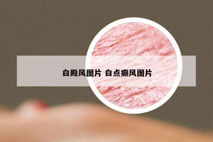 白殿风图片 白点癫风图片