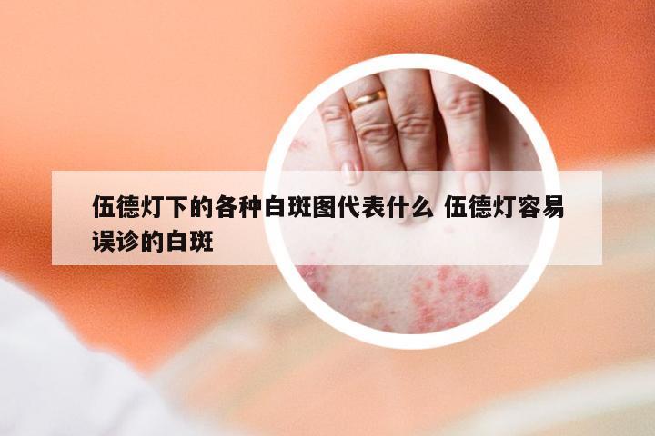 伍德灯下的各种白斑图代表什么 伍德灯容易误诊的白斑