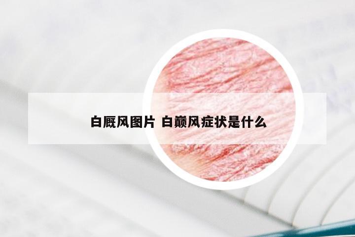 白厩风图片 白巅风症状是什么