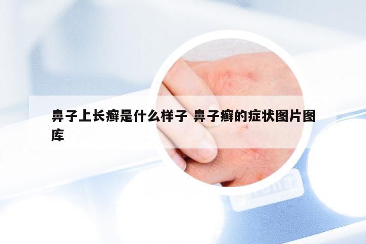 鼻子上长癣是什么样子 鼻子癣的症状图片图库