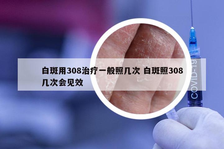 白斑用308治疗一般照几次 白斑照308几次会见效