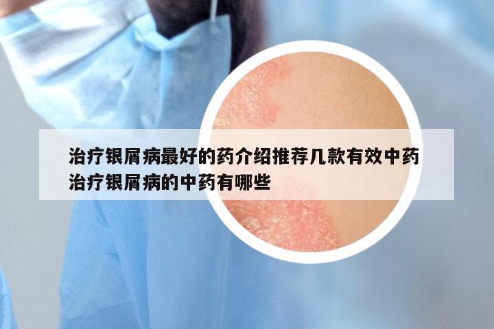 治疗银屑病最好的药介绍推荐几款有效中药 治疗银屑病的中药有哪些