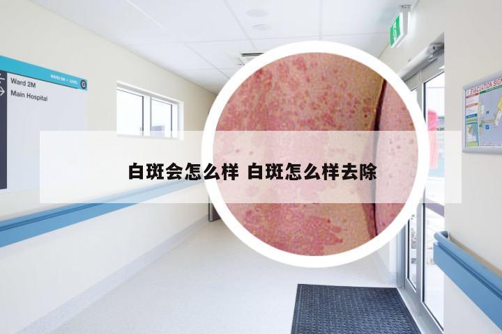 白斑会怎么样 白斑怎么样去除