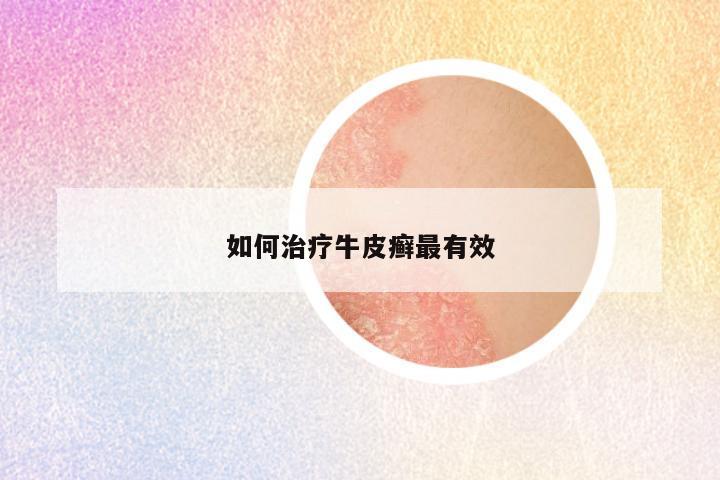 如何治疗牛皮癣最有效