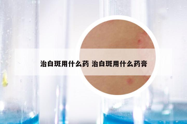 治白斑用什么药 治白斑用什么药膏