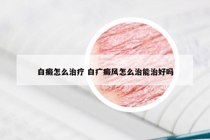 白癜怎么治疗 白疒癜风怎么治能治好吗
