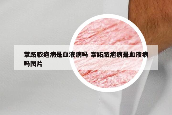 掌跖脓疱病是血液病吗 掌跖脓疱病是血液病吗图片