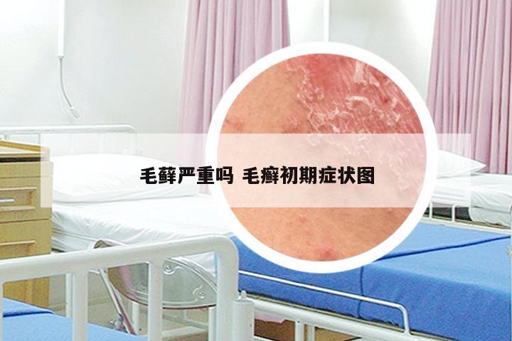 毛藓严重吗 毛癣初期症状图
