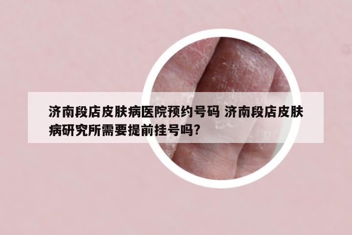 济南段店皮肤病医院预约号码 济南段店皮肤病研究所需要提前挂号吗?