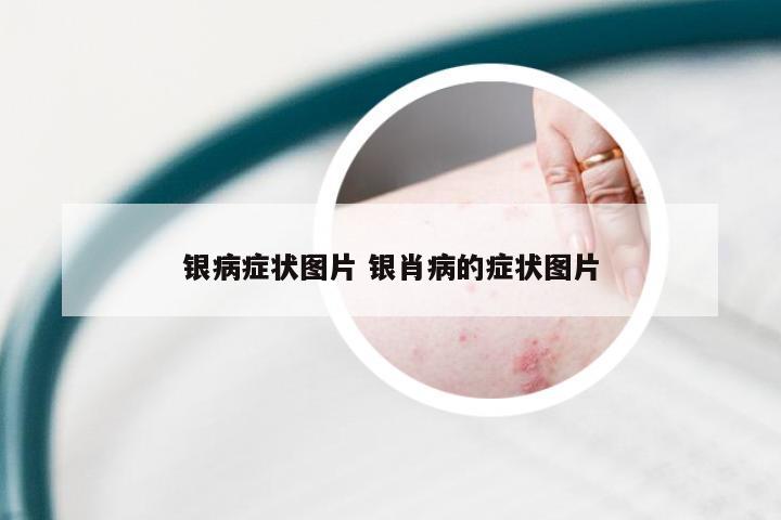 银病症状图片 银肖病的症状图片