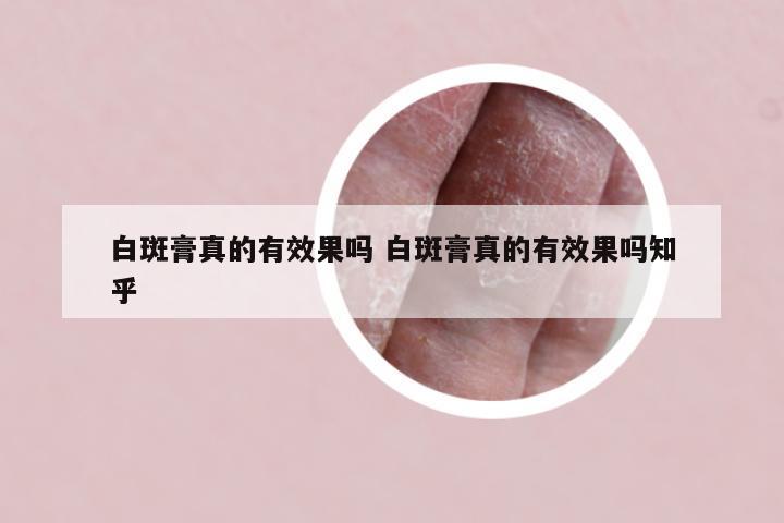 白斑膏真的有效果吗 白斑膏真的有效果吗知乎