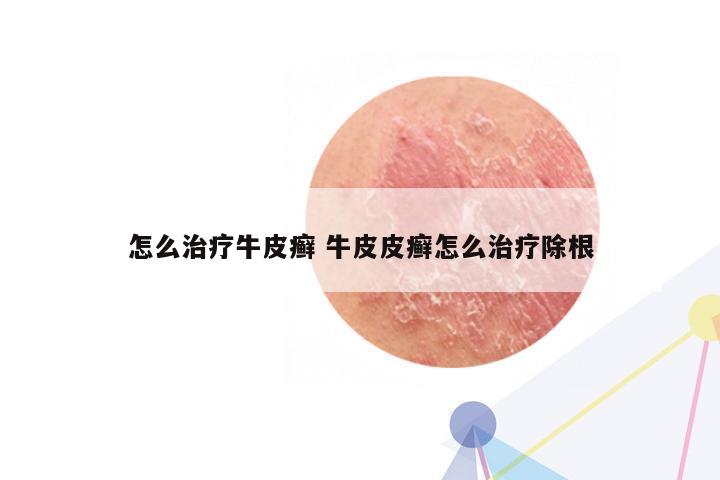 怎么治疗牛皮癣 牛皮皮癣怎么治疗除根