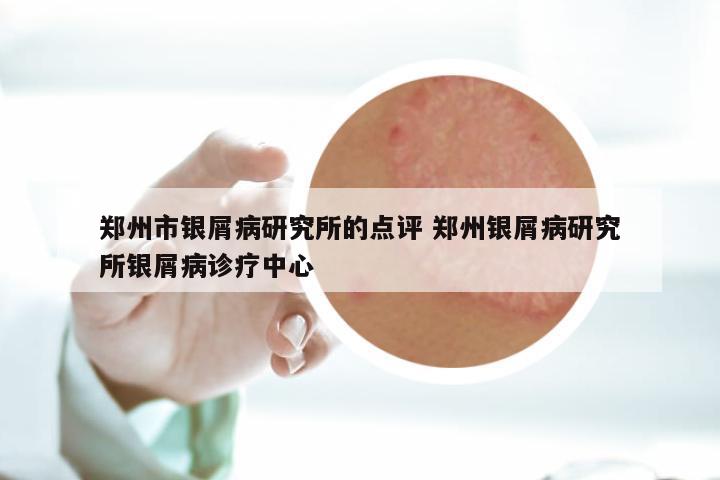 郑州市银屑病研究所的点评 郑州银屑病研究所银屑病诊疗中心