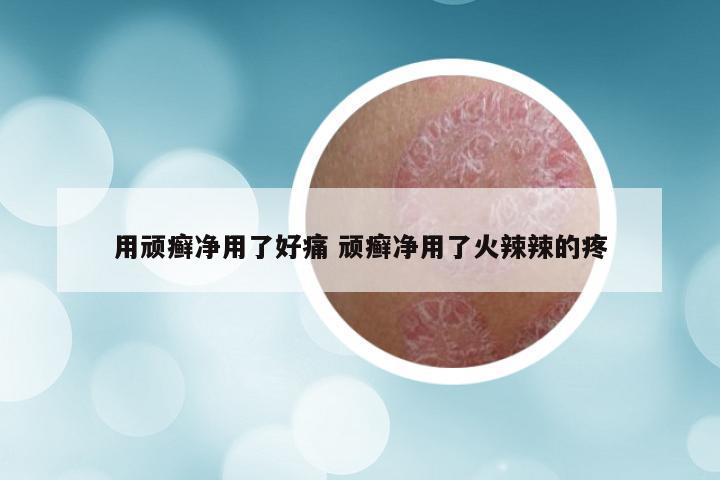 用顽癣净用了好痛 顽癣净用了火辣辣的疼