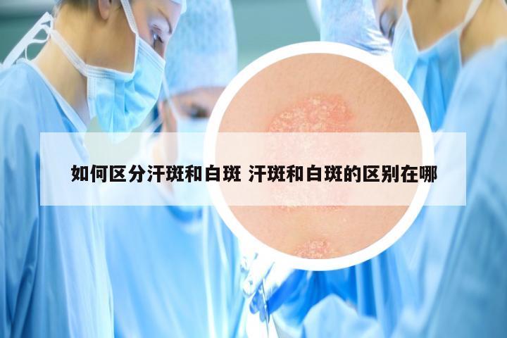 如何区分汗斑和白斑 汗斑和白斑的区别在哪