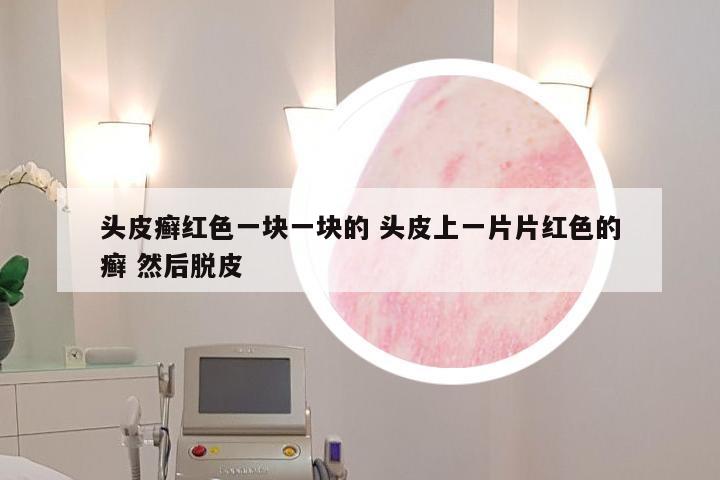 头皮癣红色一块一块的 头皮上一片片红色的癣 然后脱皮