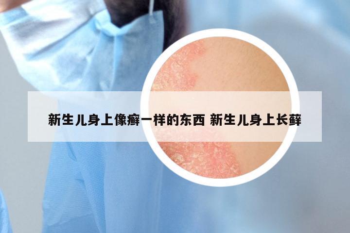 新生儿身上像癣一样的东西 新生儿身上长藓