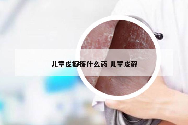 儿童皮癣擦什么药 儿童皮藓
