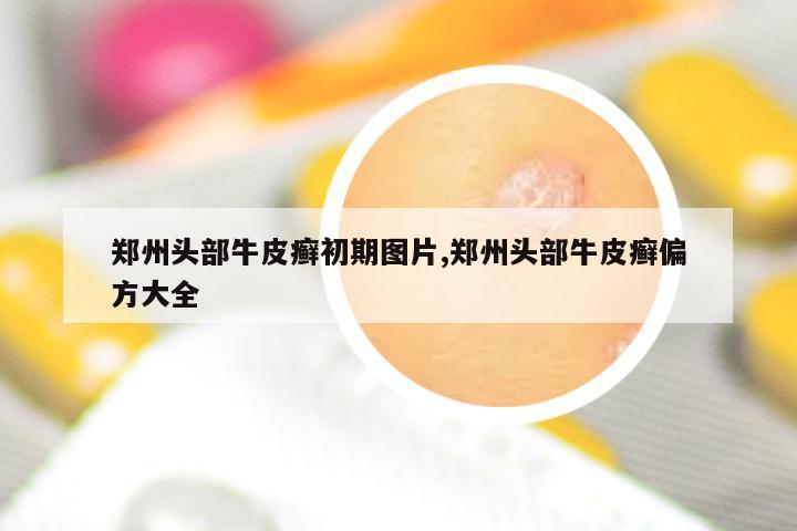 郑州头部牛皮癣初期图片,郑州头部牛皮癣偏方大全