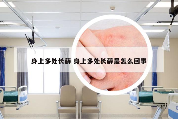 身上多处长藓 身上多处长藓是怎么回事