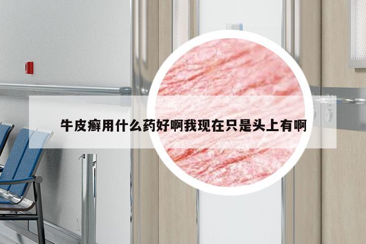 牛皮癣用什么药好啊我现在只是头上有啊