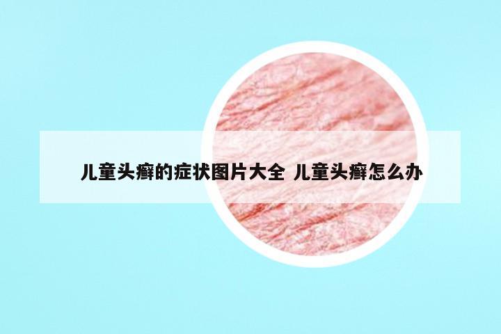 儿童头癣的症状图片大全 儿童头癣怎么办