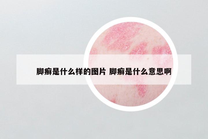 脚癣是什么样的图片 脚癣是什么意思啊