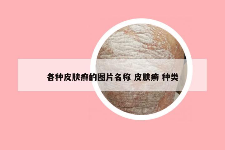各种皮肤癣的图片名称 皮肤癣 种类