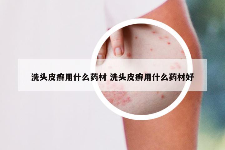 洗头皮癣用什么药材 洗头皮癣用什么药材好