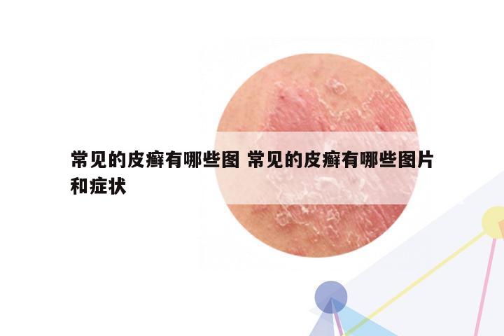 常见的皮癣有哪些图 常见的皮癣有哪些图片和症状