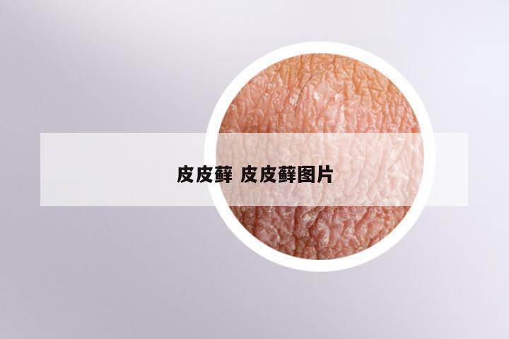 皮皮藓 皮皮藓图片